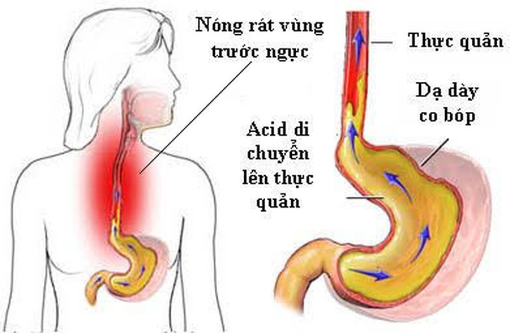 Bệnh Trào ngược dạ dày thực quản: Nguyên nhân, biến chứng và cách điều trị